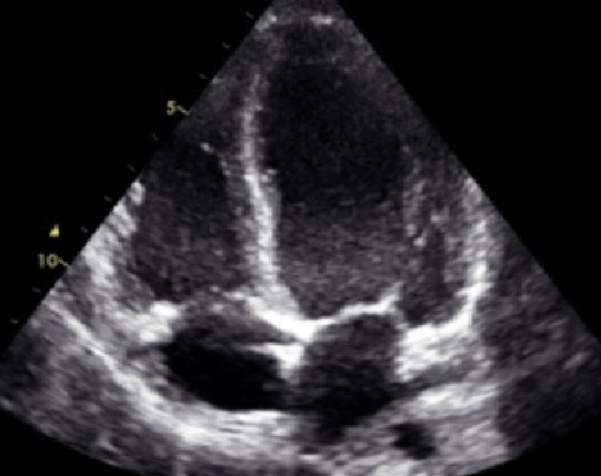 Echocardiogram